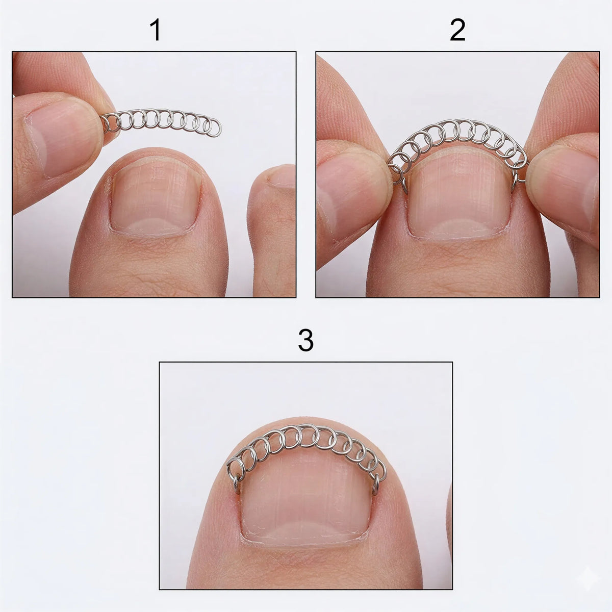 Steg för steg: så fästs nagelbygeln över tånageln.